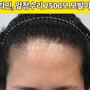 중앙헤어라인 이미지