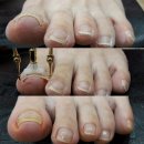 야시손톱 이미지