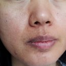 정안침으로 기미, uneven pigmentation(색소) 제거하기 이미지