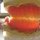 complet denture !!! 이미지
