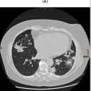 약물 유발성 간질성 폐질환(Drug Induced Interstitial Lung Disease) 이미지