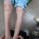 Foot drop 이미지