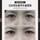 신논현눈밑지수술병원, 같은 나이인데 인상이 달라 보이는 이유
