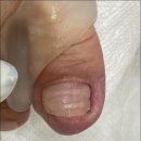 레푸스인하대역점 내성발톱 무좀발톱 발각질 문제성발 네이버블로그
