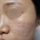 10월10일한의원 | 피부관리 | 안양범계 PDRN 피부재생주사 내돈내산 후기(한의원에서도 리쥬란이 가능! a.k.a 미주란 약침)