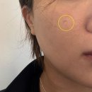 목동은한의원 | 당산여드름흉터 한의원 패인 흉터 새살침관리 1회차 솔직후기 (효과/부작용)