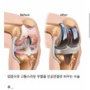 인공 관절 수술 후 느끼는 최악의 고통 이미지