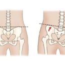 골반교정 필라테스 이미지