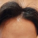 청라 비선체 에스테틱 남자 퓨라셀 관리, 왜 필요할까?