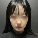 홍대고운세상피부과에서 볼뉴머리프팅 받아 본 후기 사진들