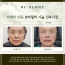동탄이마필러, 이마필러잘하는곳 후기와 보톡스와 차이점 정리