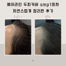 강남 두피커버 SMP 헤어라인 가르마 1회차 후기 닷센스 서초점｜전후 비교로 보는 자연스러운 변화