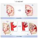 뇌동정맥 기형의 증상[언어장애, 의식장애, 시력손실, 어지럼증, 신체마비, 치매, 간질발작, 두통] 이미지