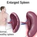 비장의 기능 위치 비대증 증상 치료 이미지
