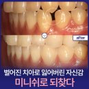 시너지심미치과기공소 | 결혼준비, 치아 투명교정 시작 (feat. 치과 3곳 상담가면서 알게된 점들 &amp; 미니쉬)