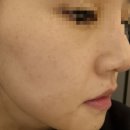 고운세상부평피부과의원 | 부평 블리비의원 아그네스 1회차 후기