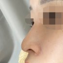 더웨이성형외과의원 | 눈코성형 후기 - 튜닝완료 <더웨이성형외과>