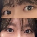 원도산 | [내돈내산] 100만 원도 안 든 첫 쌍꺼풀 수술 리얼 후기 2편