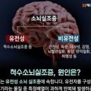 소뇌위축증 초기 증상 원인 자세히 이미지