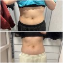 세연온마음의원 | 압구정역 다이어트의원 엔드컷 지방분해주사 복부 옆구리 맞고 온 후기 예신관리 추천