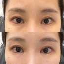밑 | 신사역 피부과 쥬베룩아이 눈 밑 주름 개선 후기 (내돈내산)
