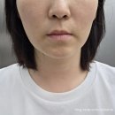 우와아 | 청담동피부과 티타늄리프팅 턱선 탄력 효과 후기