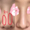 [광고 X] 압구정 코조각주사 내돈내산 후기