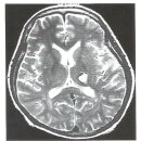 2.뇌출혈[intracerebral hemorrhage] 이미지