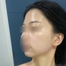 기장피부관리 일광에스테틱 미민뷰티 MTS관리 후기