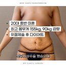 거상 | 복부 거상 후기, -90kg 감량 후 상체 거상 수술! 3개월차 리얼 후기