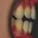 서울특별시청치과의원 | 돌출입 발치 재교정, 개방교합과 비대칭이 생긴 증례의 치료 후기