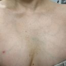 목동은한의원 | 목동한의원에서 여드름흉터 가드름 없애고 온 후기