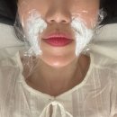 참좋은피부과의원 | 신논현 피부과 루엘의원 온다리프팅 팔자필러 일주일 후기