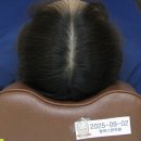 선진한의원 | 여자 정수리 탈모, 가르마가 넓어지는 느낌이 든다면 바로 치료해야할 시기
