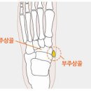 부주상골증후군 부주상골 증후군 원인 부주상골 증후군 부주상골증후군 군대 이미지