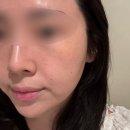 청담 | 청담 고우리 PCL 솔직후기 | 청담 피부과 고우리스킨부스터 가격, 효과, 통증까지
