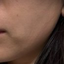 심부볼 제거 부작용? “내돈내산” 불독살 처짐 리프팅 시술 후기
