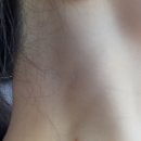 탄현경희한의원 | [공지] 탄현동 점 쥐젖 사마귀 제거 비급여 진료비 정찰제 안내