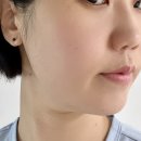 부산서면피부과 슈링크 유니버스 300샷 후기