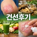 남동 | 남동구건선 후기 / 동래구건선 후기 (무료샘플)