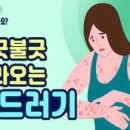 "샤워하고 두드러기가 났어요"...두드러기를 유발하는 다양한 원인 이미지