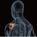 혁신오케이정형외과의원 | 오십견 '유착성 관절낭염' 옷 벗기 힘들어요ㅠㅠ