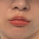더플랜의원 | 깊어진 팔자주름 고민 해결! 잠실새내 라라플랜의원 쥬베룩 볼륨 1회차 리얼 후기 (가격/통증/결절 유무)