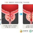 전립선비대증 실손의료비 인정요건[연령 50세 이상, 전립선 용적 100cc 미만,IPSS(국제전립선증상점수) 점수가 8점 이상] 이미지