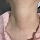 용한의원 | [신촌 피부과] 어머니 편평사마귀 제거 시술 시켜드린 내돈내산 후기 &#39;신촌 한의원&#39;
