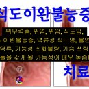 폭식 장애 치료 - 사암오행침, 사암침법, 오행침, 정통사암침 이미지