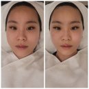 로하나 | 강남구청 로하나코스킨 추천 : 💎원쎄라 리프팅 후기💎