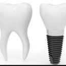 테마주 정리 :: 치아 치료(임플란트 등) 이미지