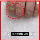 내성발톱발톱무좀관리김수정뷰티 이미지