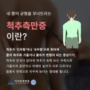 성장기 주의해야 할 척추질환, 척추측만증 이미지